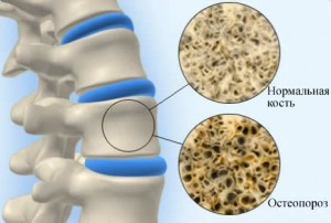 На пути к крепким костям: лечится ли остеопороз? Лечим остеопороз в домашних условиях простыми способами.